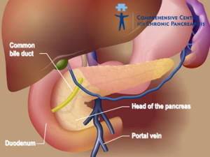 Ce este pancreatita cronica