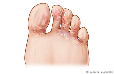 micoză între tratarea degetelor
